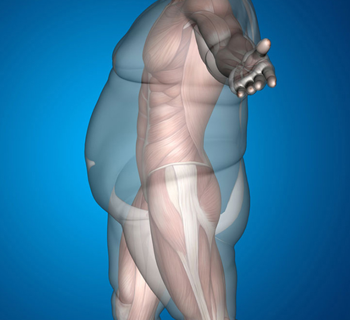 Gastrik Bypass