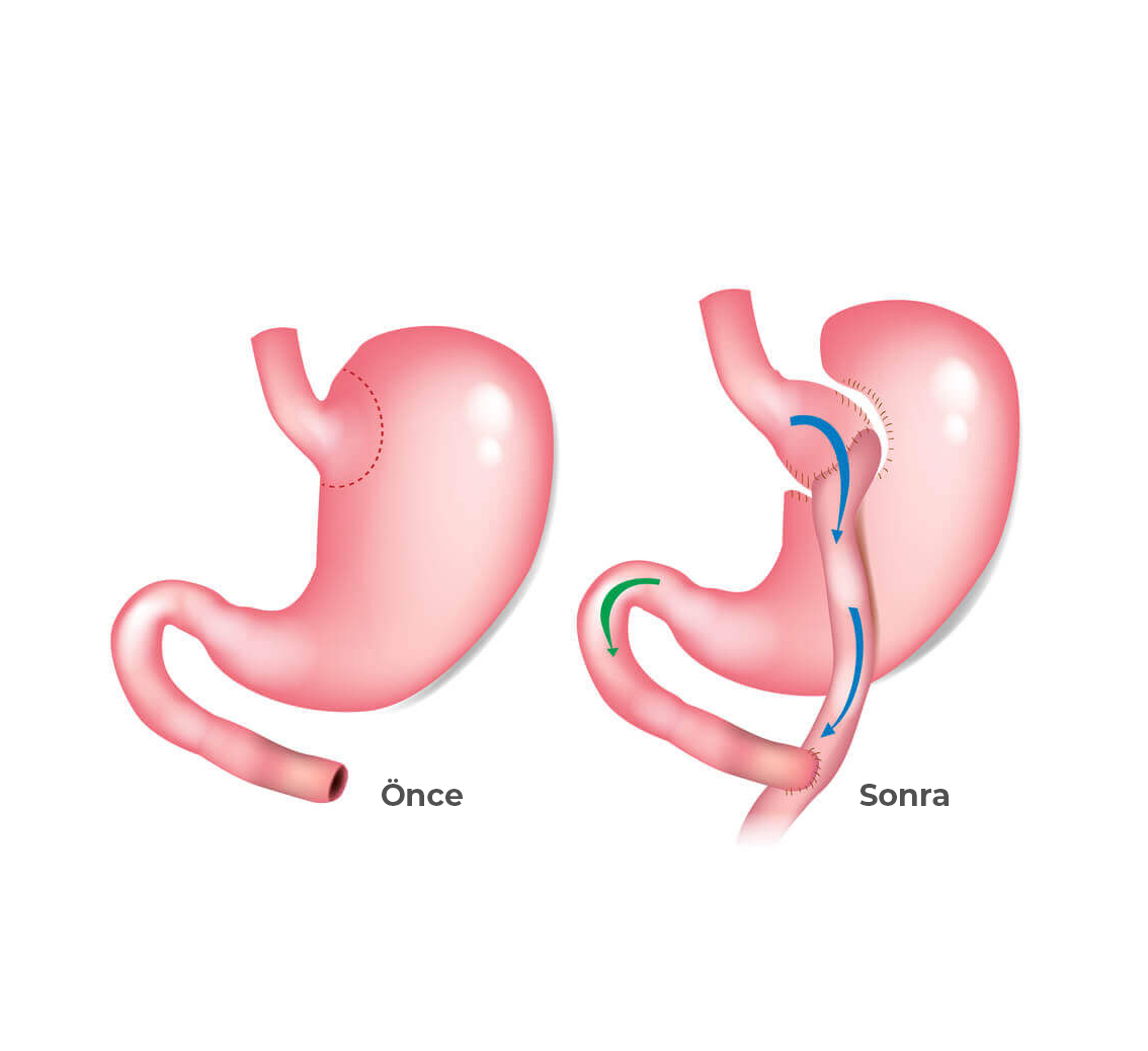 Gastrik Bypass Ameliyatı Nedir?
